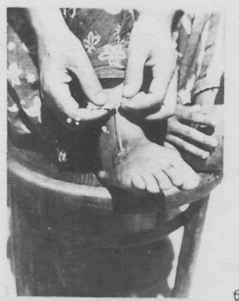 1925 Бухара Извлечение Ришты Табибом